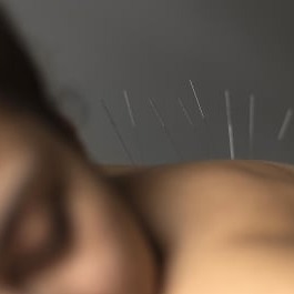 Dry Needling